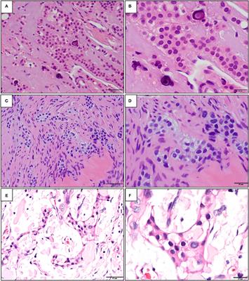 Non-calcifying Langerhans Cell Rich Variant of Calcifying Epithelial Odontogenic Tumor and Amyloid Rich Variant of Central Odontogenic Fibroma: A Unique Entity or a Spectrum?